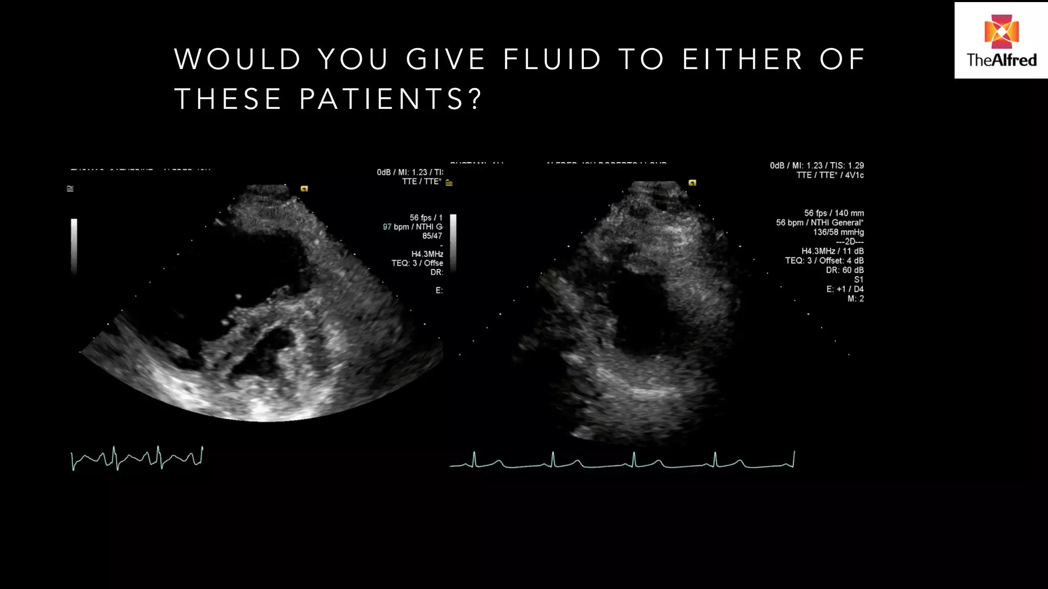 WOULD YOU GIVE FLUID TO EITHER OF 
THESE PATIENTS? 
 