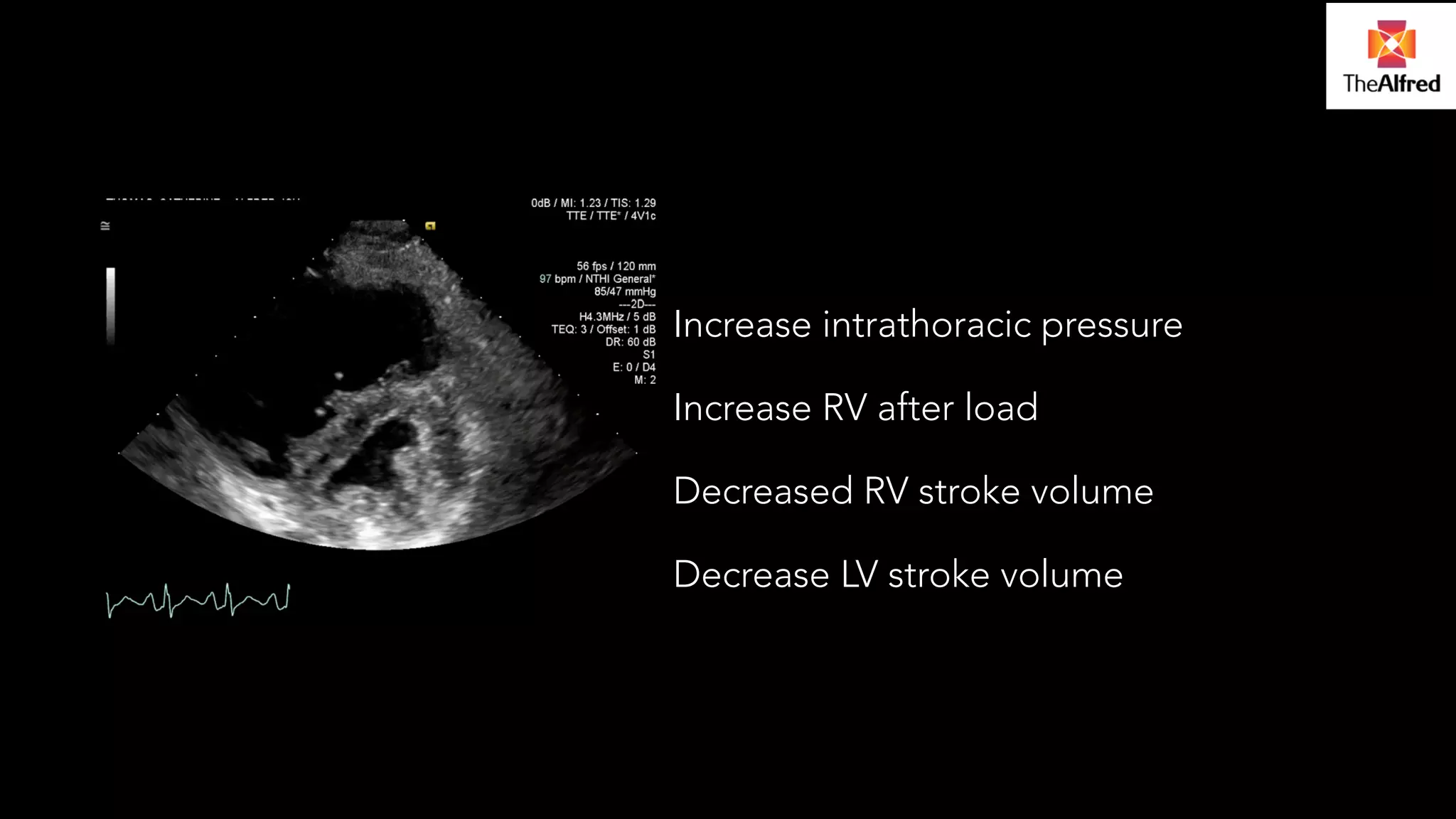 Increase intrathoracic pressure 
Increase RV after load 
Decreased RV stroke volume 
Decrease LV stroke volume 
 