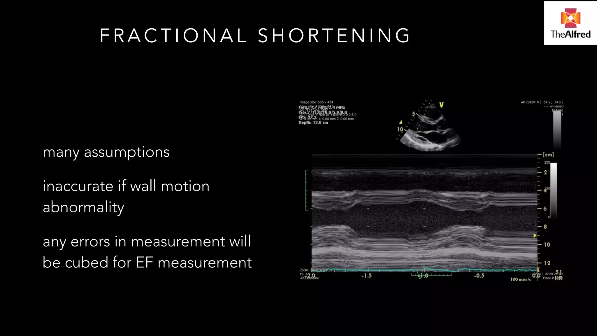 FRACTIONAL SHORTENING 
! 
many assumptions 
inaccurate if wall motion 
abnormality 
any errors in measurement will 
be cubed for EF measurement 
 