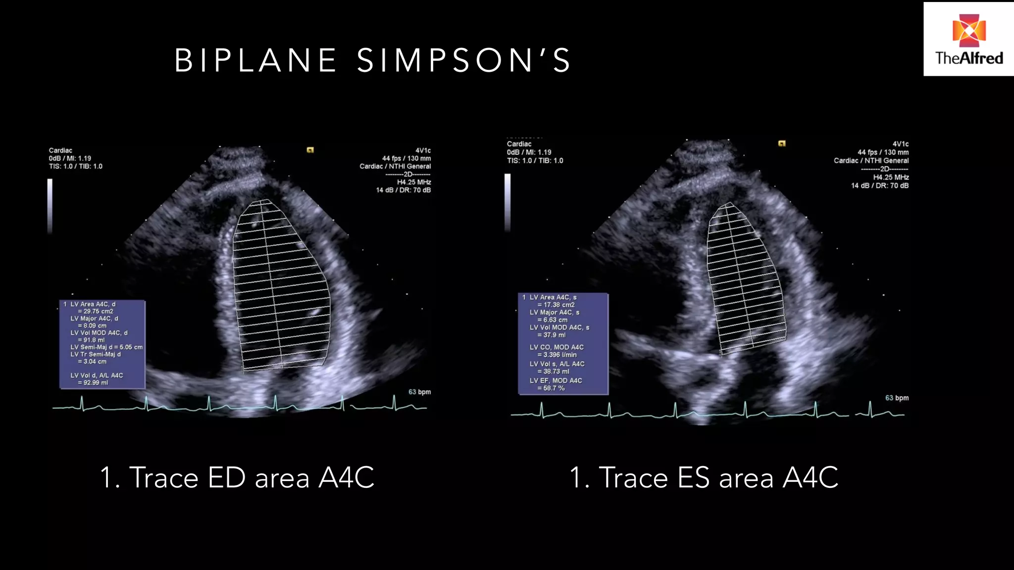 BIPLANE SIMPSON’S 
1. Trace ED area A4C 1. Trace ES area A4C 
 