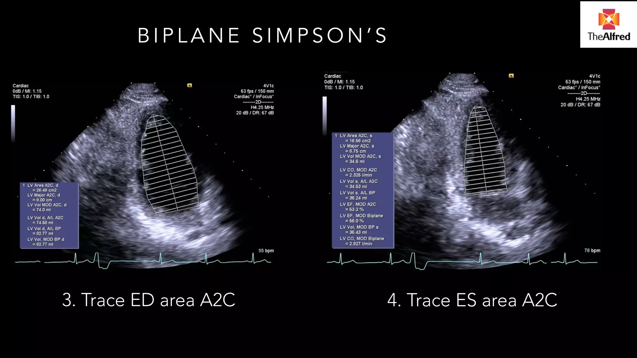 BIPLANE SIMPSON’S 
3. Trace ED area A2C 4. Trace ES area A2C 
 