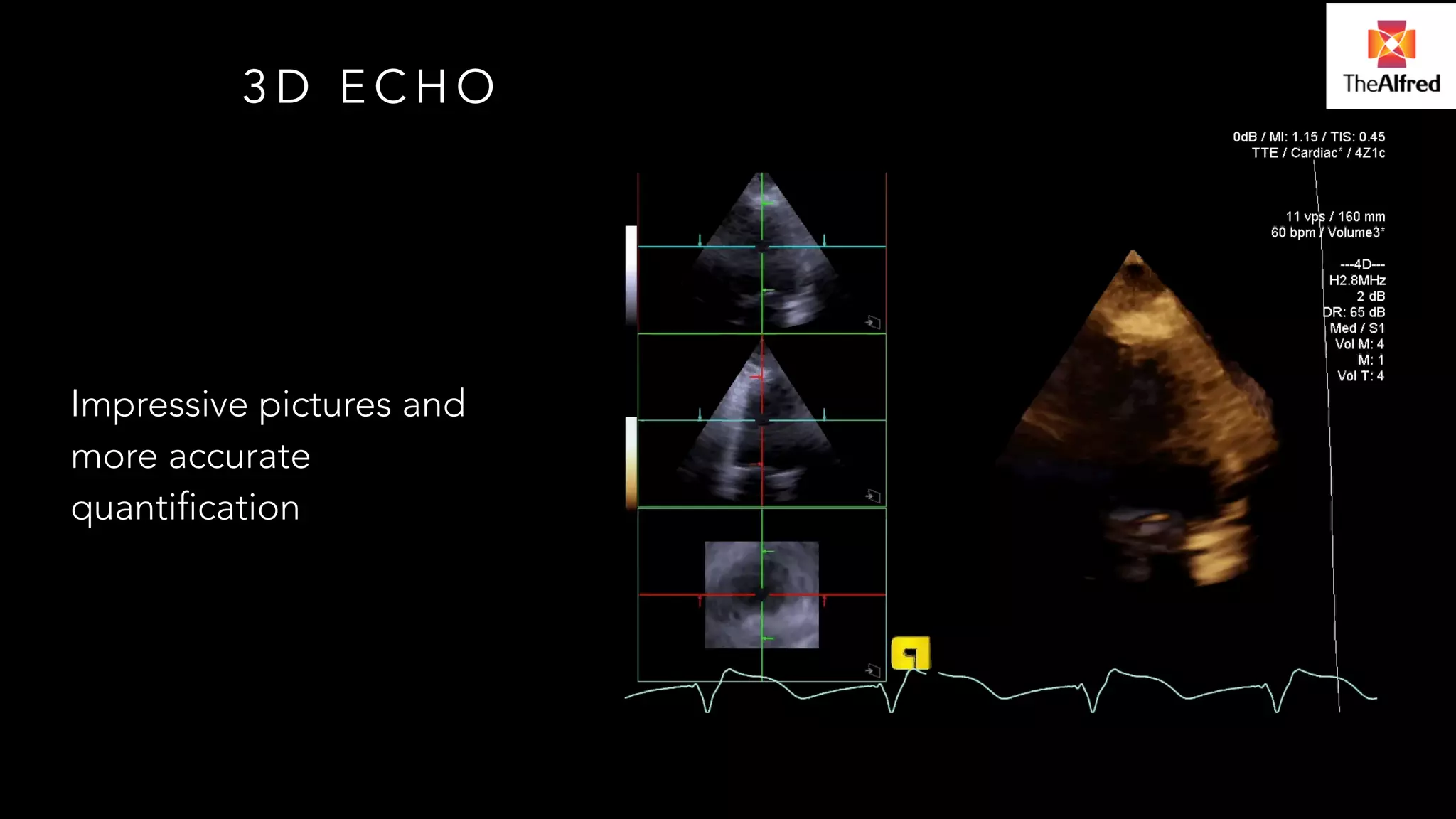 3D ECHO 
Impressive pictures and 
more accurate 
quantification 
 