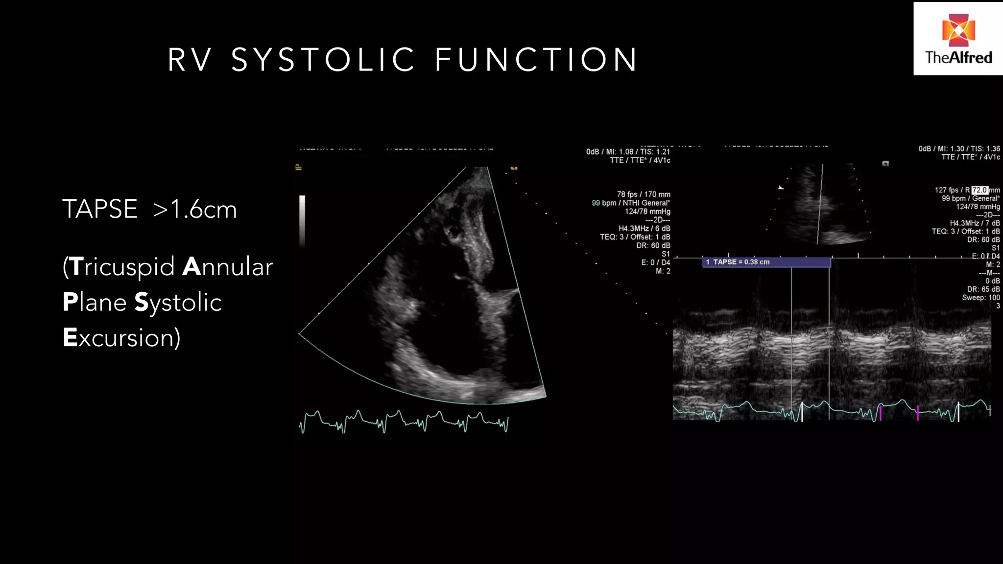 RV SYSTOLIC FUNCTION 
TAPSE >1.6cm 
(Tricuspid Annular 
Plane Systolic 
Excursion) 
 