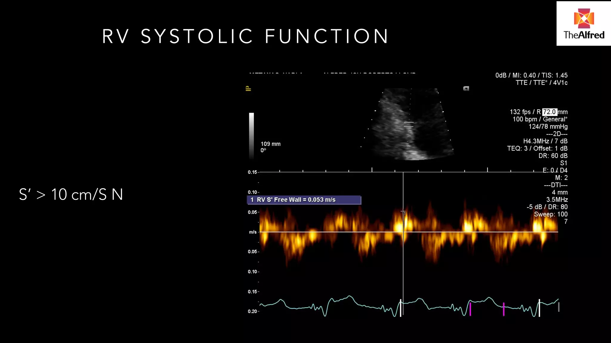 RV SYSTOLIC FUNCTION 
S’ > 10 cm/S N 
 