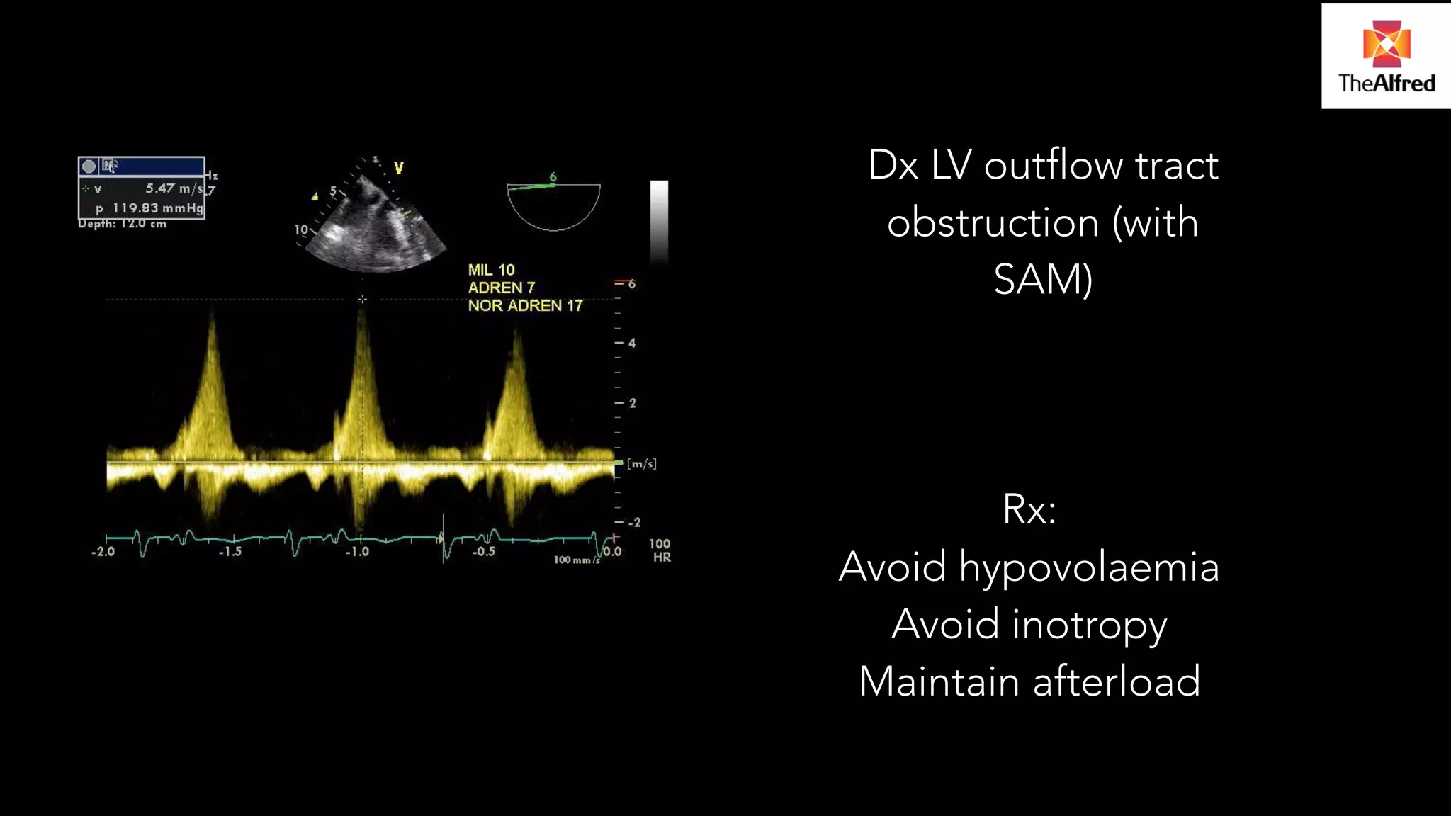 Dx LV outflow tract 
obstruction (with 
SAM) 
Rx: 
Avoid hypovolaemia 
Avoid inotropy 
Maintain afterload 
 