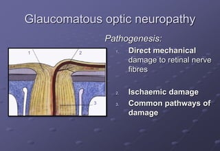 Glaucomatous optic neuropathy
Pathogenesis:
1. Direct mechanical
damage to retinal nerve
fibres
2. Ischaemic damage
3. Common pathways of
damage
1 2
3
 