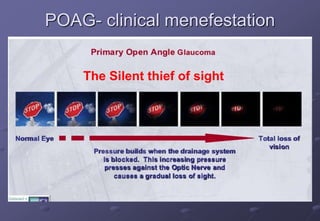 POAG- clinical menefestation
The Silent thief of sight
 