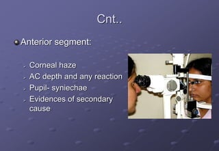 Cnt..
Anterior segment:
 Corneal haze
 AC depth and any reaction
 Pupil- syniechae
 Evidences of secondary
cause
 
