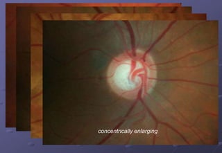 Focal ischaemic – inferior notch and disc
haemorrhage
myopic;
sclerotic
concentrically enlarging
 