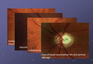 baring of inferior circumlinear
blood vessel
bayoneting of blood vessels
collateral vessels
loss of nasal neuroretinal rim and laminar
dot sign
 