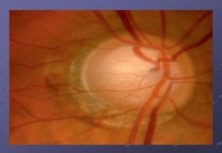 Ctn…
Peripapillary changes
1. Alpha (outer) zone is characterized by
superficial retinal pigment epithelial changes
2. Beta (inner) zone is characterized by
chorioretinal atrophy
 