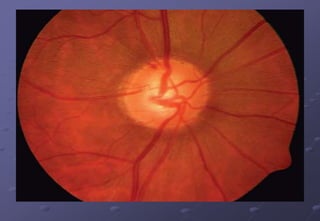 Ctn..
Retinal nerve fibre layer
1. Localized wedge-shaped defects and
2. Diffuse defects that are larger and have
indistinct borders
 