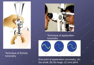Technique of Schiotz
tonometry
Technique of applanation
tonometry
End point of applanation tonometry. (A)
too small; (B) too large; (C) end point.
 