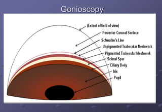 Gonioscopy
The technique of biomicroscopic examination of
the angle of the anterior chamber using a
goniolens.
The angle structures seen from behind forward
are:
1. Root of the iris
2. Ciliary body band
3. Scleral spur
4. Trabecular meshwork
5. Schwalbe’s line
 