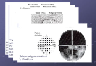 A paracentral
scotoma- loss of
nerve fibers
ininferotemporal
retina
The arcuate
scotoma-10-
20° from
fixation-
Bjerrum
scotoma
Nasal step
Altitudinal defect
Advanced glaucomatous
V. Field loss
 