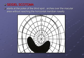 SEIDEL SCOTOMA
starts at the poles of the blind spot , arches over the macular
area without reaching the horizontal meridian nasally
 
