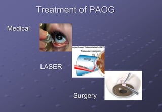 Treatment of PAOG
Medical
LASER
Surgery
 