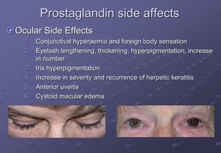 Prostaglandin side affects
Ocular Side Effects
1. Conjunctival hyperaemia and foreign body sensation
2. Eyelash lengthening, thickening, hyperpigmentation, increase
in number
3. Iris hyperpigmentation
4. Increase in severity and recurrence of herpetic keratitis
5. Anterior uveitis
6. Cystoid macular edema
 