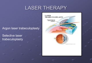 LASER THERAPY
Argon laser trabeculoplasty
Selective laser
trabeculoplasty
 