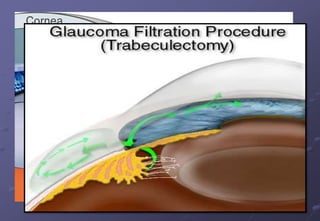 Surgical
TRABECULECTOMY:
Involves creation of fistula between angle of anterior
chamber and sub Tenon’s space
 