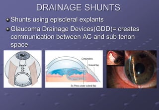 DRAINAGE SHUNTS
Shunts using episcleral explants
Glaucoma Drainage Devices(GDD)= creates
communication between AC and sub tenon
space
 