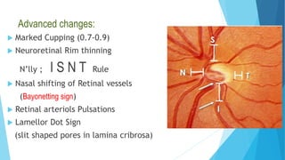 Advanced changes:
 Marked Cupping (0.7-0.9)
 Neuroretinal Rim thinning
N’lly ; I S N T Rule
 Nasal shifting of Retinal vessels
(Bayonetting sign)
 Retinal arteriols Pulsations
 Lamellor Dot Sign
(slit shaped pores in lamina cribrosa)
 