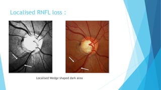 Localised RNFL loss :
Localised Wedge shaped dark area
 