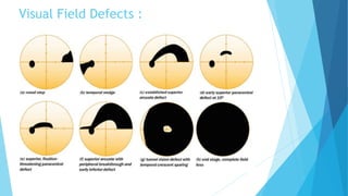 Visual Field Defects :
 