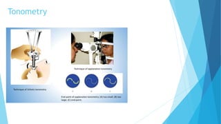 Tonometry
 