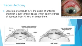 Trabeculectomy
 Creation of a fistula b/w the angle of anterior
chamber & sub-tenon’s space which allows egress
of aqueous from AC to a drainage bleb.
 