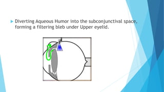  Diverting Aqueous Humor into the subconjunctival space,
forming a filtering bleb under Upper eyelid.
 