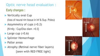 Optic nerve head evaluation :
 Vertically oval Cup
(loss of neural rim tissue in Inf & Sup. Poles)
 Assymmetry of cups (>0.2)
{N’mlly : Cup/Disc diam .=0.3}
 Large cup (>0.6)
 Splinter Hemorrhage
 Pallor areas
 Atrophy (Retinal nerve fiber layers)
{seen with RED FREE light}
Early changes :
 
