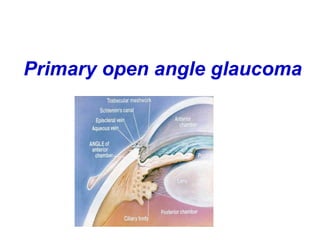 Primary open angle glaucoma
 