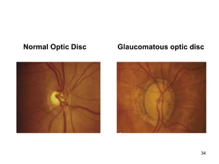 Normal Optic Disc Glaucomatous optic disc
34
 