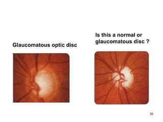 Glaucomatous optic disc
Is this a normal or
glaucomatous disc ?
35
 