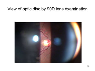 View of optic disc by 90D lens examination
37
 