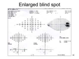 Enlarged blind spot
44
 