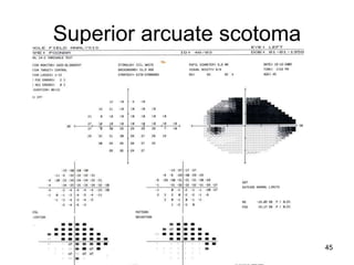 Superior arcuate scotoma
45
 