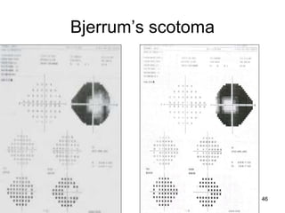 Bjerrum’s scotoma
46
 