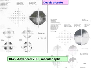Double arcuate
10-2- Advanced VFD , macular split
48
 