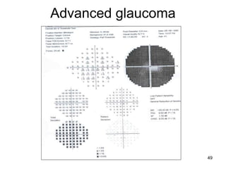 Advanced glaucoma
49
 