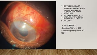 Primary open angle glaucoma presentation | PPTX