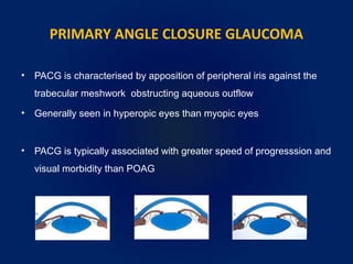 PRIMARY ANGLE CLOSURE GLAUCOMA
• PACG is characterised by apposition of peripheral iris against the
trabecular meshwork obstructing aqueous outflow
• Generally seen in hyperopic eyes than myopic eyes
• PACG is typically associated with greater speed of progresssion and
visual morbidity than POAG
 