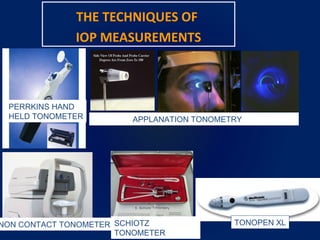 THE TECHNIQUES OF
IOP MEASUREMENTS
APPLANATION TONOMETRY
SCHIOTZ
TONOMETER
PERRKINS HAND
HELD TONOMETER
TONOPEN XLNON CONTACT TONOMETER
 