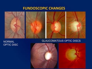 FUNDOSCOPIC CHANGES
NORMAL
OPTIC DISC
GLAUCOMATOUS OPTIC DISCS
 