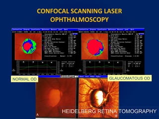 CONFOCAL SCANNING LASER
OPHTHALMOSCOPY
HEIDELBERG RETINA TOMOGRAPHY
NORMAL OD GLAUCOMATOUS OD
 