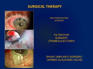 SURGICAL THERAPY
SHUNT (IMPLANT) SURGERY
(AHMED GLAUCOMA VALVE)
FILTRATION
SURGERY
(TRABECULECTOMY)
NON PENETRATING
SURGERY
 