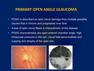 PRIMARY OPEN ANGLE GLAUCOMA
• POAG is described as optic nerve damage from multiple possible
causes that is chronic and progresses over time
• A loss of optic nerve fibers is characteristic of the disease
• POAG characteristics are open anterior chamber angle, high
intraocular pressure in the eye ,visual field abnormalities and
cupping and atrophy of the optic disc
 