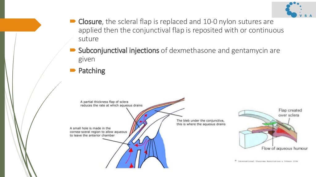 Primary open angle surgical management