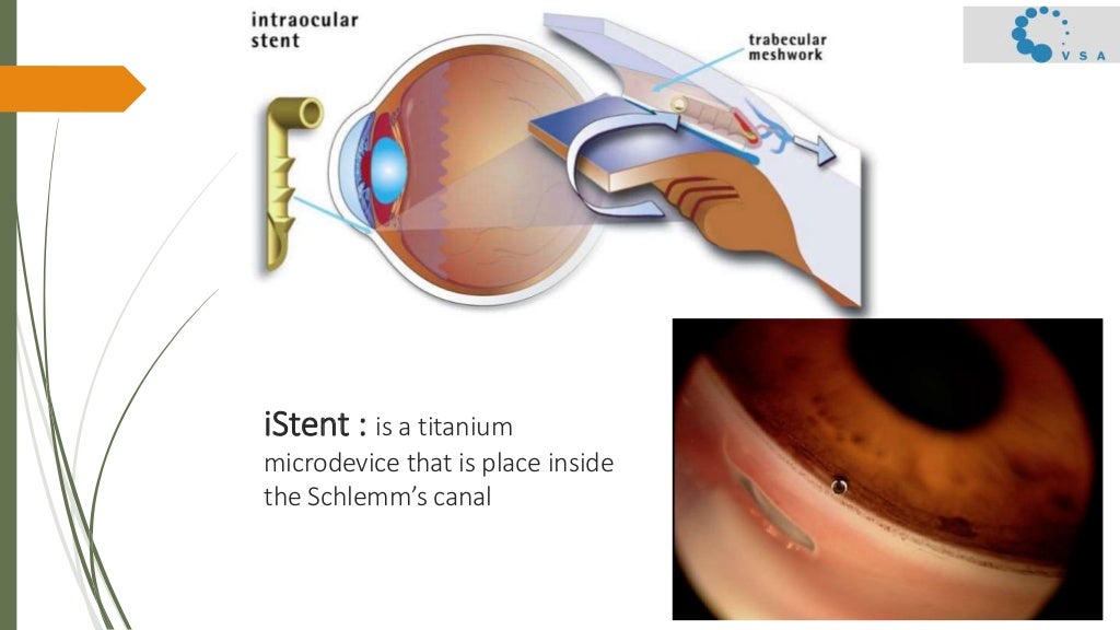 Primary open angle surgical management